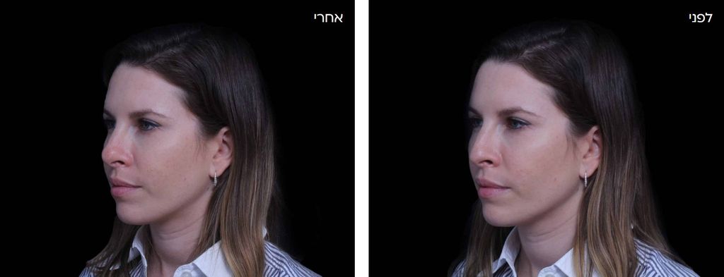 מתוך האתר של ד"ר אופיר שיין פיסול אף